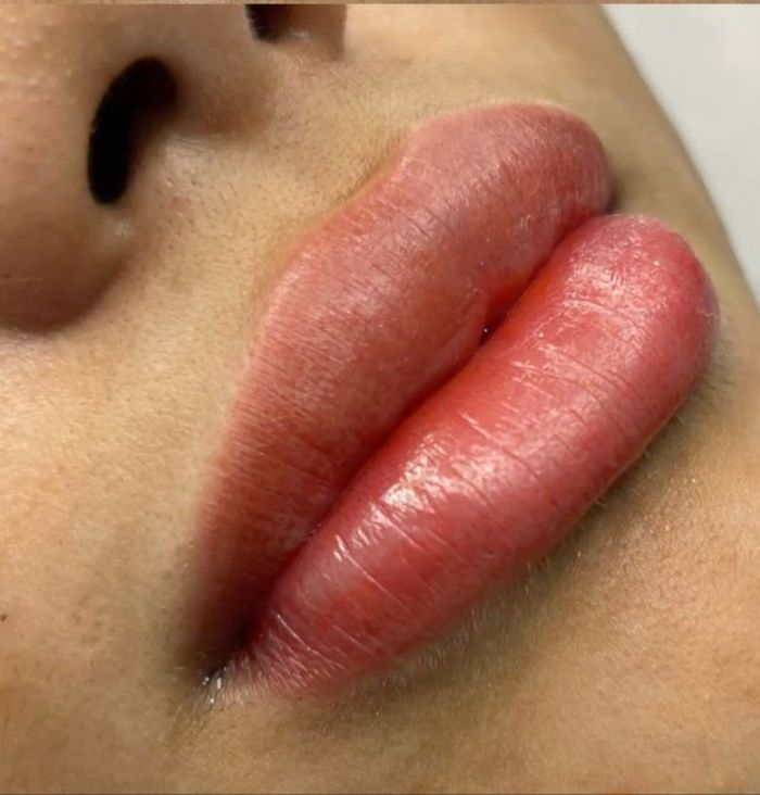 Neutralización de Labios